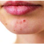 What Causes Acne?