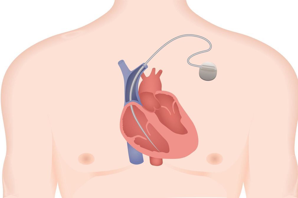 all-about-implantable-cardiac-defibrillators-(icds)